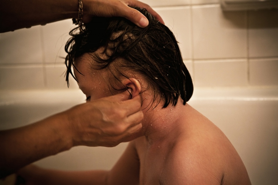 孤兒?。呼~鱗病女孩的艱難生活【圖】