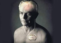 起搏器真的能治好帕金森病嗎？