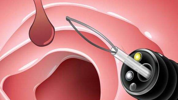【健康解碼&middot;小貼士】檢查出息肉 需要切除嗎？