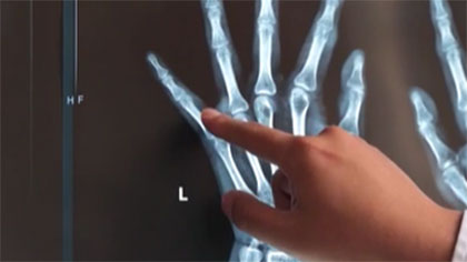 飲食不節(jié)制 19歲小伙兒全身遍布&ldquo;痛風(fēng)石&rdquo;