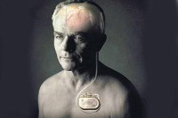 【健康解碼】起搏器真的能治好帕金森病嗎？